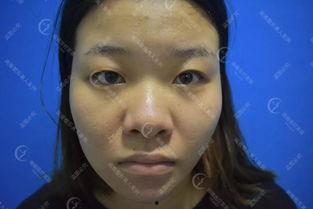 明星双眼皮割的太长的,明星双眼皮过长引发热议